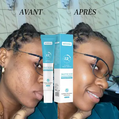 Gel Anti-Acné MOOYAM à l'Acide Salicylique